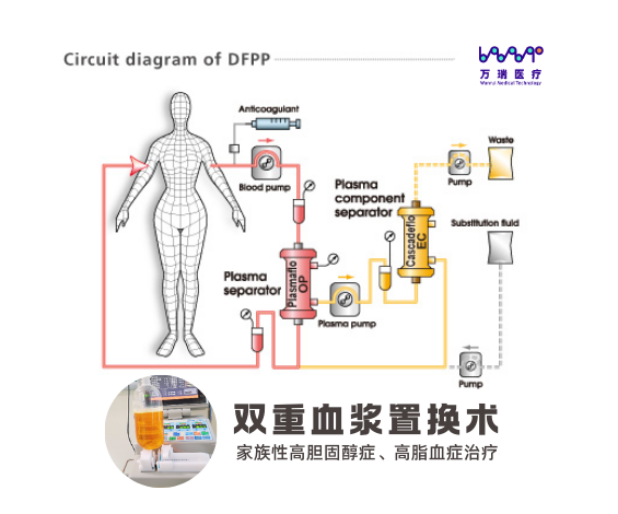 DFPP双重血浆置换术